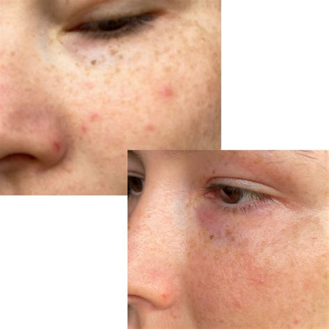 pollen nation online|Honey Shots Clearing Gel: Skin Blemishes & Acne Treatment .